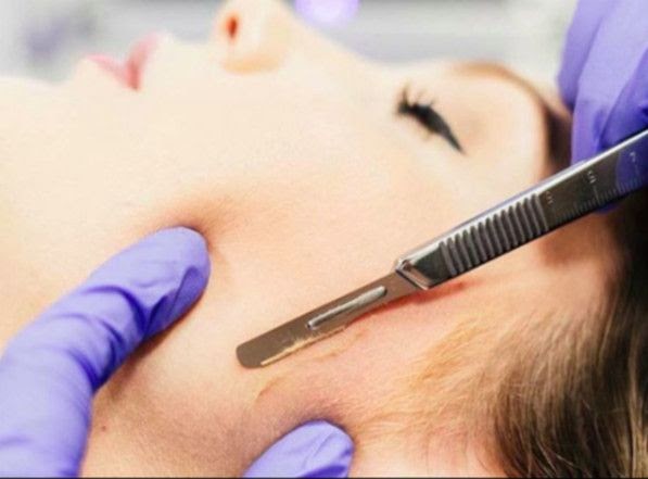 dermaplaning1